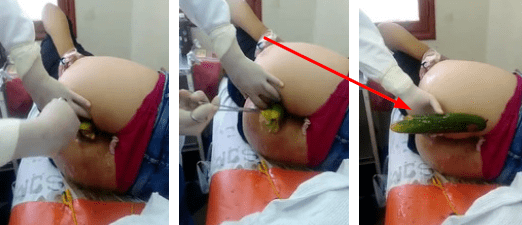 Doctor obtengo una emergencia de pepino